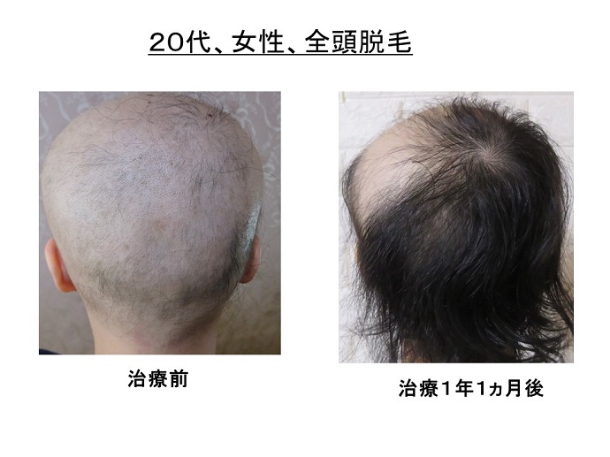 円形脱毛症　病院